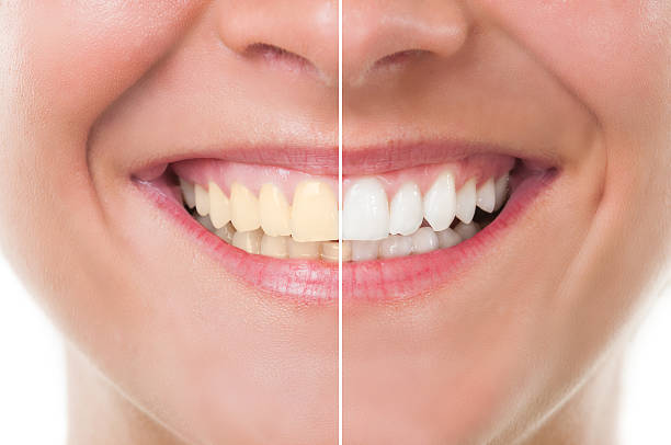 The Best Method of Teeth Whitening